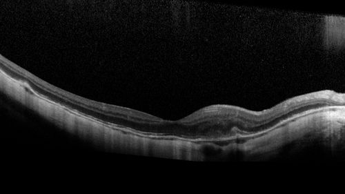 Rapid macular atrophy with anti-VEGF therapy for myopic CNVM
64 year old female with 20/32 vision and distortion in the left and better eye.  She was treated with monthly lucentis and her vision declined to 20/100.  Medicine was stopped and she improved a little to 20/80.
