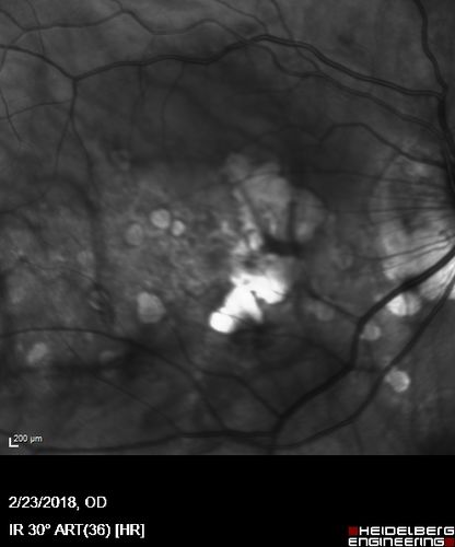 Rapid macular atrophy with anti-VEGF therapy for myopic CNVM
64 year old female with 20/32 vision and distortion in the left and better eye.  She was treated with monthly lucentis and her vision declined to 20/100.  Medicine was stopped and she improved a little to 20/80.
