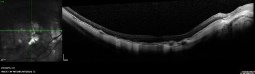 Rapid macular atrophy with anti-VEGF therapy for myopic CNVM
64 year old female with 20/32 vision and distortion in the left and better eye.  She was treated with monthly lucentis and her vision declined to 20/100.  Medicine was stopped and she improved a little to 20/80.
