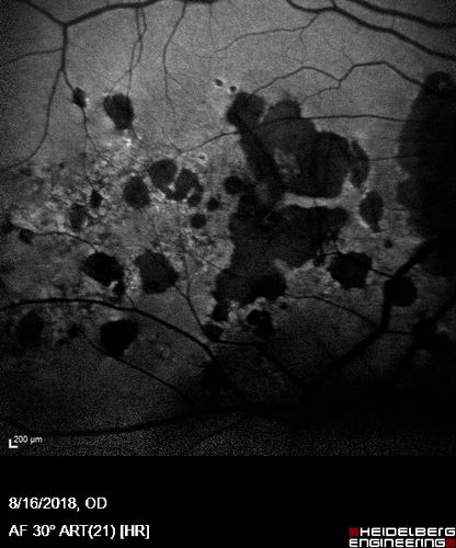 Rapid macular atrophy with anti-VEGF therapy for myopic CNVM
64 year old female with 20/32 vision and distortion in the left and better eye.  She was treated with monthly lucentis and her vision declined to 20/100.  Medicine was stopped and she improved a little to 20/80.
