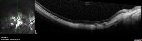 Rapid macular atrophy with anti-VEGF therapy for myopic CNVM
64 year old female with 20/32 vision and distortion in the left and better eye.  She was treated with monthly lucentis and her vision declined to 20/100.  Medicine was stopped and she improved a little to 20/80.
