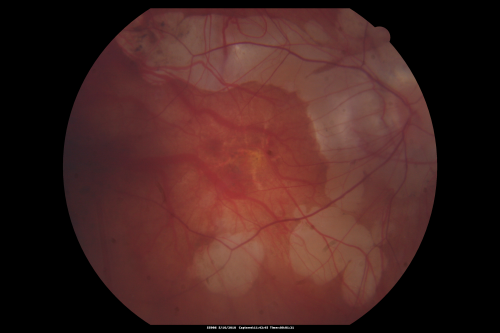 Myopic Degeneration - Staphyloma - Atrophy
53-year-old man was a -15.00 myope. He is aphakic.  His left eye also had a retinal detachment repair and unfortunately the left eye does not see well.  He is on Timolol in both eyes for glaucoma.  VISUAL ACUITY:  OD 20/50,  OS: Faint light perception. 
Keywords: myopia;myopic;staphyloma;geographic atrophy