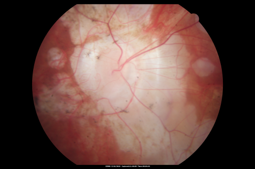 Myopic Degeneration - Staphyloma - Atrophy
53-year-old man was a -15.00 myope. He is aphakic.  His left eye also had a retinal detachment repair and unfortunately the left eye does not see well.  He is on Timolol in both eyes for glaucoma.  VISUAL ACUITY:  OD 20/50,  OS: Faint light perception. 
Keywords: myopia;myopic;staphyloma;geographic atrophy