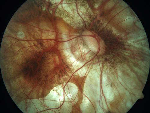 Myopic CNVM in the left eye.  New Classic subfoveal lesion
64 year old female.  She had retinal detachment repair in the right eye in 1996 (25 years ago).  The left eye has new distortion for a week or two.
VA 20/40 OU.
Left eye has a very small subfoveal CNVM
