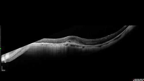 Myopic CNVM in the left eye.  New Classic subfoveal lesion
64 year old female.  She had retinal detachment repair in the right eye in 1996 (25 years ago).  The left eye has new distortion for a week or two.
VA 20/40 OU.
Left eye has a very small subfoveal CNVM
