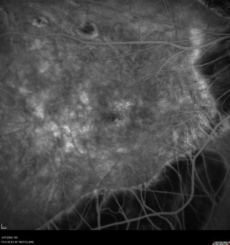 Myopic CNVM in the left eye.  New Classic subfoveal lesion
64 year old female.  She had retinal detachment repair in the right eye in 1996 (25 years ago).  The left eye has new distortion for a week or two.
VA 20/40 OU.
Left eye has a very small subfoveal CNVM
