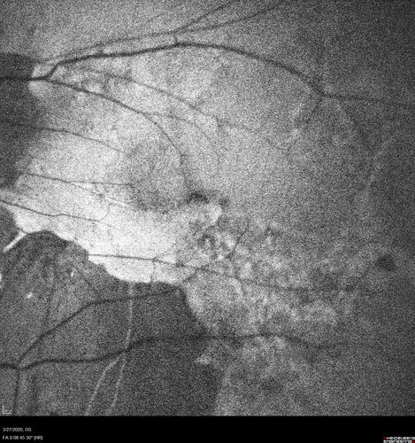 Myopic CNVM in the left eye.  New Classic subfoveal lesion
64 year old female.  She had retinal detachment repair in the right eye in 1996 (25 years ago).  The left eye has new distortion for a week or two.
VA 20/40 OU.
Left eye has a very small subfoveal CNVM
