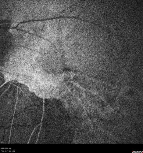 Myopic CNVM in the left eye.  New Classic subfoveal lesion
64 year old female.  She had retinal detachment repair in the right eye in 1996 (25 years ago).  The left eye has new distortion for a week or two.
VA 20/40 OU.
Left eye has a very small subfoveal CNVM
