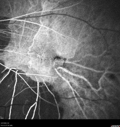 Myopic CNVM in the left eye.  New Classic subfoveal lesion
64 year old female.  She had retinal detachment repair in the right eye in 1996 (25 years ago).  The left eye has new distortion for a week or two.
VA 20/40 OU.
Left eye has a very small subfoveal CNVM
