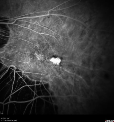 Myopic CNVM in the left eye.  New Classic subfoveal lesion
64 year old female.  She had retinal detachment repair in the right eye in 1996 (25 years ago).  The left eye has new distortion for a week or two.
VA 20/40 OU.
Left eye has a very small subfoveal CNVM
