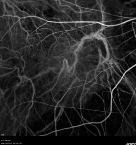 Myopic CNVM in the left eye.  New Classic subfoveal lesion
64 year old female.  She had retinal detachment repair in the right eye in 1996 (25 years ago).  The left eye has new distortion for a week or two.
VA 20/40 OU.
Left eye has a very small subfoveal CNVM
