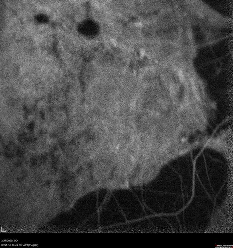 Myopic CNVM in the left eye.  New Classic subfoveal lesion
64 year old female.  She had retinal detachment repair in the right eye in 1996 (25 years ago).  The left eye has new distortion for a week or two.
VA 20/40 OU.
Left eye has a very small subfoveal CNVM
