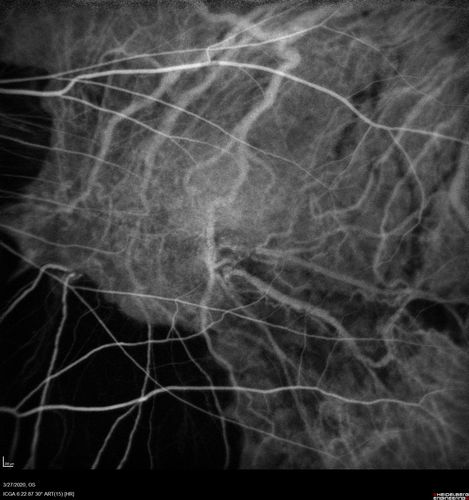 Myopic CNVM in the left eye.  New Classic subfoveal lesion
64 year old female.  She had retinal detachment repair in the right eye in 1996 (25 years ago).  The left eye has new distortion for a week or two.
VA 20/40 OU.
Left eye has a very small subfoveal CNVM
