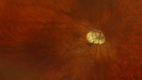 Stable Myopic Tractional Maculopathy
73 year old female with mild vision loss from table myopic tractional maculopathy in  the left eye
