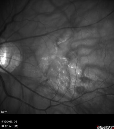 Stable Myopic Tractional Maculopathy
73 year old female with mild vision loss from table myopic tractional maculopathy in  the left eye

