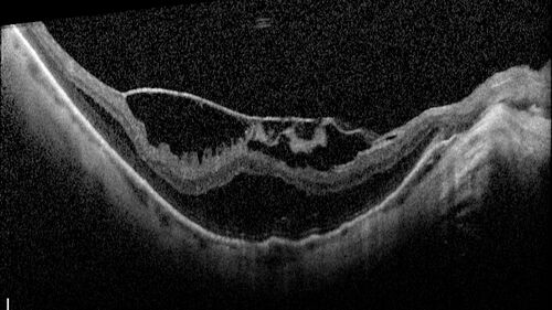 Stable Myopic Tractional Maculopathy
73 year old female with mild vision loss from table myopic tractional maculopathy in  the left eye
