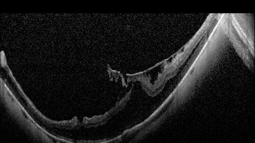 Stable Myopic Tractional Maculopathy
73 year old female with mild vision loss from table myopic tractional maculopathy in  the left eye
