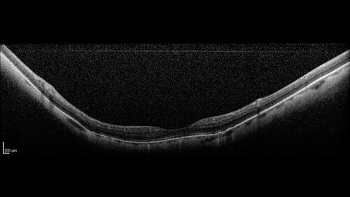 Stable Myopic Tractional Maculopathy
73 year old female with mild vision loss from table myopic tractional maculopathy in  the left eye

