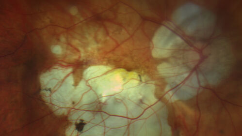 Myopic CNVM Left Eye
80 year old female.  VA dropped to 20/125 but improved back up to 20/50 with Vabysmo
