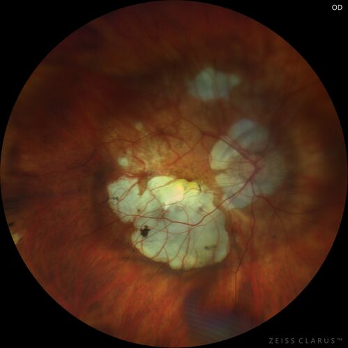Myopic CNVM Left Eye
80 year old female.  VA dropped to 20/125 but improved back up to 20/50 with Vabysmo
