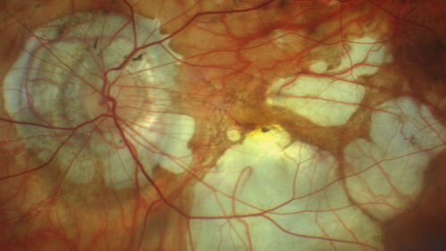 Myopic CNVM Left Eye
80 year old female.  VA dropped to 20/125 but improved back up to 20/50 with Vabysmo

