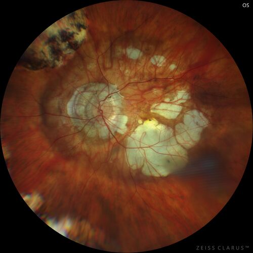 Myopic CNVM Left Eye
80 year old female.  VA dropped to 20/125 but improved back up to 20/50 with Vabysmo
