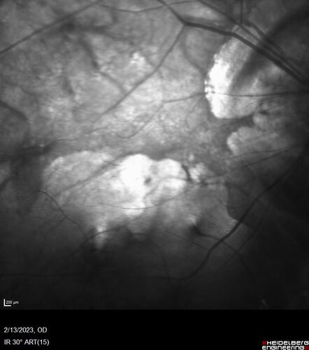Myopic CNVM Left Eye
80 year old female.  VA dropped to 20/125 but improved back up to 20/50 with Vabysmo
