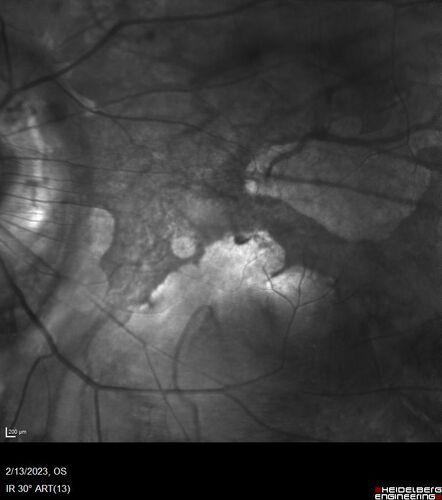 Myopic CNVM Left Eye
80 year old female.  VA dropped to 20/125 but improved back up to 20/50 with Vabysmo
