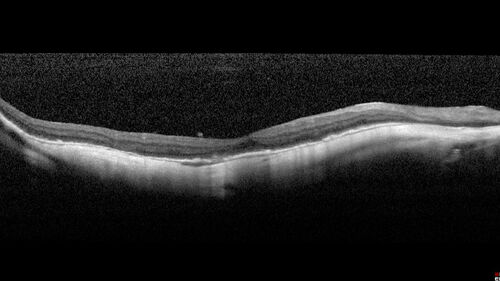 Myopic CNVM Left Eye
80 year old female.  VA dropped to 20/125 but improved back up to 20/50 with Vabysmo
