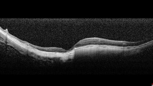 Myopic CNVM Left Eye
80 year old female.  VA dropped to 20/125 but improved back up to 20/50 with Vabysmo
