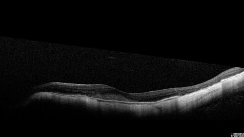 Myopic CNVM Left Eye
80 year old female.  VA dropped to 20/125 but improved back up to 20/50 with Vabysmo
