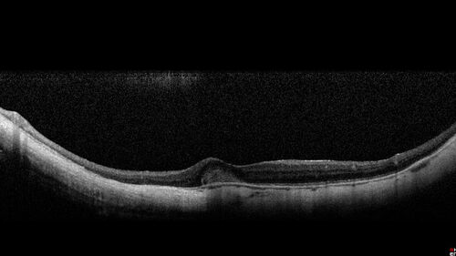 Myopic CNVM Left Eye
80 year old female.  VA dropped to 20/125 but improved back up to 20/50 with Vabysmo
