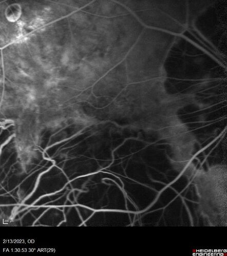 Myopic CNVM Left Eye
80 year old female.  VA dropped to 20/125 but improved back up to 20/50 with Vabysmo
