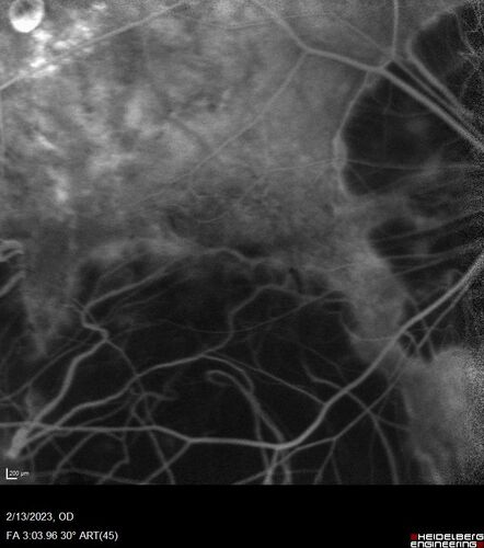 Myopic CNVM Left Eye
80 year old female.  VA dropped to 20/125 but improved back up to 20/50 with Vabysmo
