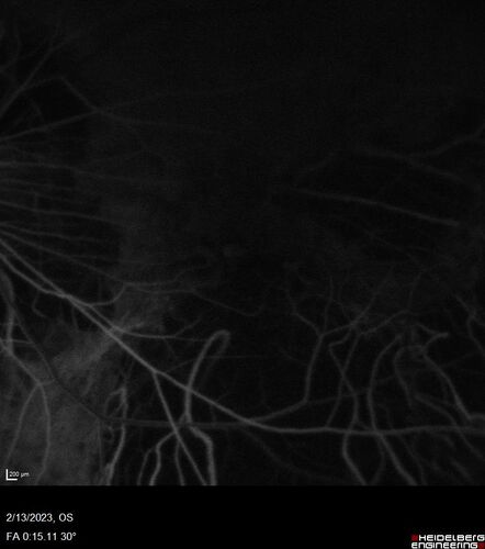 Myopic CNVM Left Eye
80 year old female.  VA dropped to 20/125 but improved back up to 20/50 with Vabysmo
