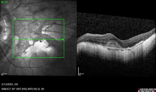 Myopic CNVM Left Eye
80 year old female.  VA dropped to 20/125 but improved back up to 20/50 with Vabysmo
