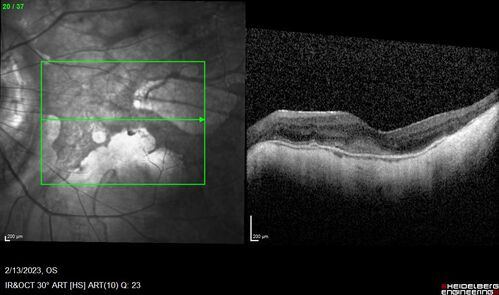 Myopic CNVM Left Eye
80 year old female.  VA dropped to 20/125 but improved back up to 20/50 with Vabysmo
