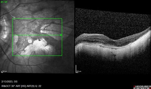 Myopic CNVM Left Eye
80 year old female.  VA dropped to 20/125 but improved back up to 20/50 with Vabysmo
