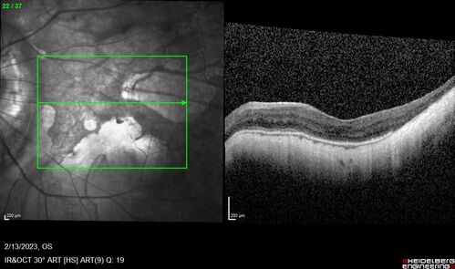 Myopic CNVM Left Eye
80 year old female.  VA dropped to 20/125 but improved back up to 20/50 with Vabysmo
