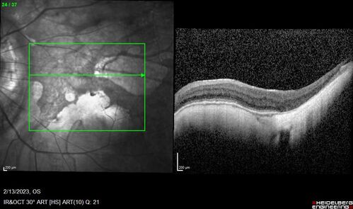 Myopic CNVM Left Eye
80 year old female.  VA dropped to 20/125 but improved back up to 20/50 with Vabysmo
