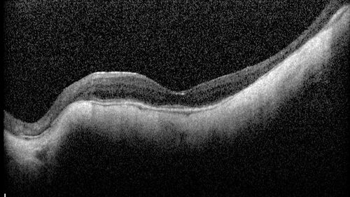 Myopic CNVM Left Eye
80 year old female.  VA dropped to 20/125 but improved back up to 20/50 with Vabysmo
