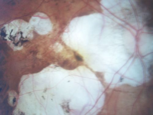 Myopic Macular Degeneration - Staphyloma - Recent Vision Loss Right Eye - Possible CNVM
83-year-old woman is a high myope with myopic macular degeneration.  She had a retinal detachment repair in the right eye in 1968.  I saw her in June of 2003.  She had posterior colobomas and areas of pigment epithelial atrophy.  She has noticed over the last six weeks substantial declining vision in the right eye.  Prior to that, the vision in the two eyes was about the same.  She uses Xalatan in the left eye and Alphagan in both eyes.

VISUAL ACUITY:  Vision OD is 20/160, OS is 20/40
