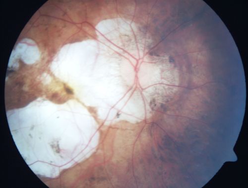 Myopic Macular Degeneration - Staphyloma - Recent Vision Loss Right Eye - Possible CNVM
83-year-old woman is a high myope with myopic macular degeneration.  She had a retinal detachment repair in the right eye in 1968.  I saw her in June of 2003.  She had posterior colobomas and areas of pigment epithelial atrophy.  She has noticed over the last six weeks substantial declining vision in the right eye.  Prior to that, the vision in the two eyes was about the same.  She uses Xalatan in the left eye and Alphagan in both eyes.

VISUAL ACUITY:  Vision OD is 20/160, OS is 20/40
