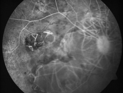 Myopic Macular Degeneration - Staphyloma - Recent Vision Loss Right Eye - Possible CNVM
83-year-old woman is a high myope with myopic macular degeneration.  She had a retinal detachment repair in the right eye in 1968.  I saw her in June of 2003.  She had posterior colobomas and areas of pigment epithelial atrophy.  She has noticed over the last six weeks substantial declining vision in the right eye.  Prior to that, the vision in the two eyes was about the same.  She uses Xalatan in the left eye and Alphagan in both eyes.

VISUAL ACUITY:  Vision OD is 20/160, OS is 20/40
