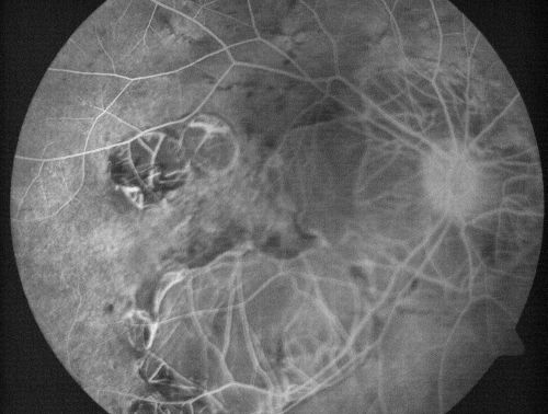 Myopic Macular Degeneration - Staphyloma - Recent Vision Loss Right Eye - Possible CNVM
83-year-old woman is a high myope with myopic macular degeneration.  She had a retinal detachment repair in the right eye in 1968.  I saw her in June of 2003.  She had posterior colobomas and areas of pigment epithelial atrophy.  She has noticed over the last six weeks substantial declining vision in the right eye.  Prior to that, the vision in the two eyes was about the same.  She uses Xalatan in the left eye and Alphagan in both eyes.

VISUAL ACUITY:  Vision OD is 20/160, OS is 20/40

