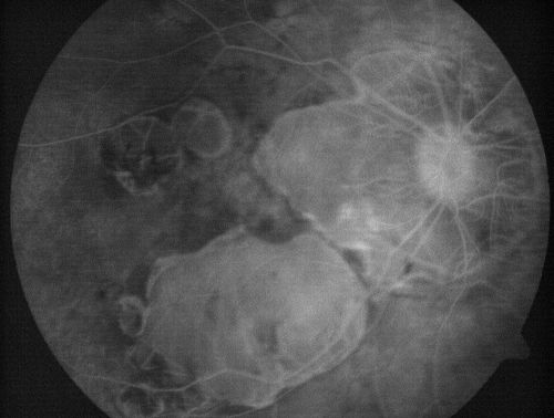 Myopic Macular Degeneration - Staphyloma - Recent Vision Loss Right Eye - Possible CNVM
83-year-old woman is a high myope with myopic macular degeneration.  She had a retinal detachment repair in the right eye in 1968.  I saw her in June of 2003.  She had posterior colobomas and areas of pigment epithelial atrophy.  She has noticed over the last six weeks substantial declining vision in the right eye.  Prior to that, the vision in the two eyes was about the same.  She uses Xalatan in the left eye and Alphagan in both eyes.

VISUAL ACUITY:  Vision OD is 20/160, OS is 20/40

