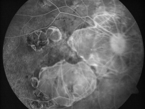 Myopic Macular Degeneration - Staphyloma - Recent Vision Loss Right Eye - Possible CNVM
83-year-old woman is a high myope with myopic macular degeneration.  She had a retinal detachment repair in the right eye in 1968.  I saw her in June of 2003.  She had posterior colobomas and areas of pigment epithelial atrophy.  She has noticed over the last six weeks substantial declining vision in the right eye.  Prior to that, the vision in the two eyes was about the same.  She uses Xalatan in the left eye and Alphagan in both eyes.

VISUAL ACUITY:  Vision OD is 20/160, OS is 20/40
