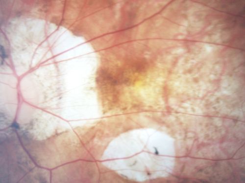 Myopic Macular Degeneration - Staphyloma - Recent Vision Loss Right Eye - Possible CNVM
83-year-old woman is a high myope with myopic macular degeneration.  She had a retinal detachment repair in the right eye in 1968.  I saw her in June of 2003.  She had posterior colobomas and areas of pigment epithelial atrophy.  She has noticed over the last six weeks substantial declining vision in the right eye.  Prior to that, the vision in the two eyes was about the same.  She uses Xalatan in the left eye and Alphagan in both eyes.

VISUAL ACUITY:  Vision OD is 20/160, OS is 20/40
