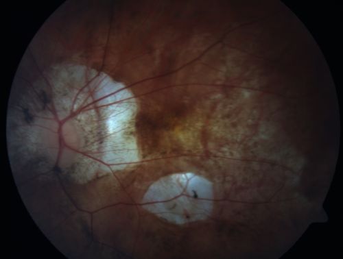 Myopic Macular Degeneration - Staphyloma - Recent Vision Loss Right Eye - Possible CNVM
83-year-old woman is a high myope with myopic macular degeneration.  She had a retinal detachment repair in the right eye in 1968.  I saw her in June of 2003.  She had posterior colobomas and areas of pigment epithelial atrophy.  She has noticed over the last six weeks substantial declining vision in the right eye.  Prior to that, the vision in the two eyes was about the same.  She uses Xalatan in the left eye and Alphagan in both eyes.

VISUAL ACUITY:  Vision OD is 20/160, OS is 20/40
