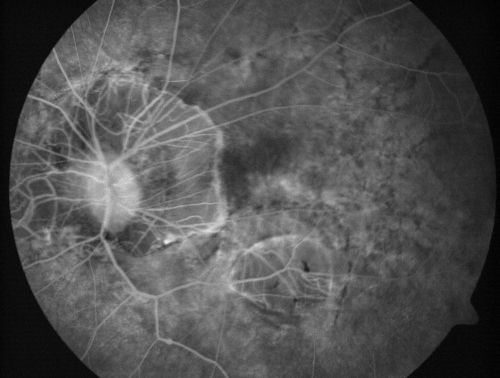 Myopic Macular Degeneration - Staphyloma - Recent Vision Loss Right Eye - Possible CNVM
83-year-old woman is a high myope with myopic macular degeneration.  She had a retinal detachment repair in the right eye in 1968.  I saw her in June of 2003.  She had posterior colobomas and areas of pigment epithelial atrophy.  She has noticed over the last six weeks substantial declining vision in the right eye.  Prior to that, the vision in the two eyes was about the same.  She uses Xalatan in the left eye and Alphagan in both eyes.

VISUAL ACUITY:  Vision OD is 20/160, OS is 20/40
